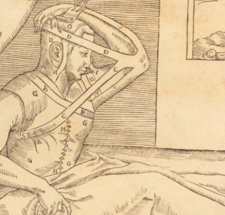 lllustration from Gaspare Tagliacozzi's De curtorum chirurgia per insitionem (1597)