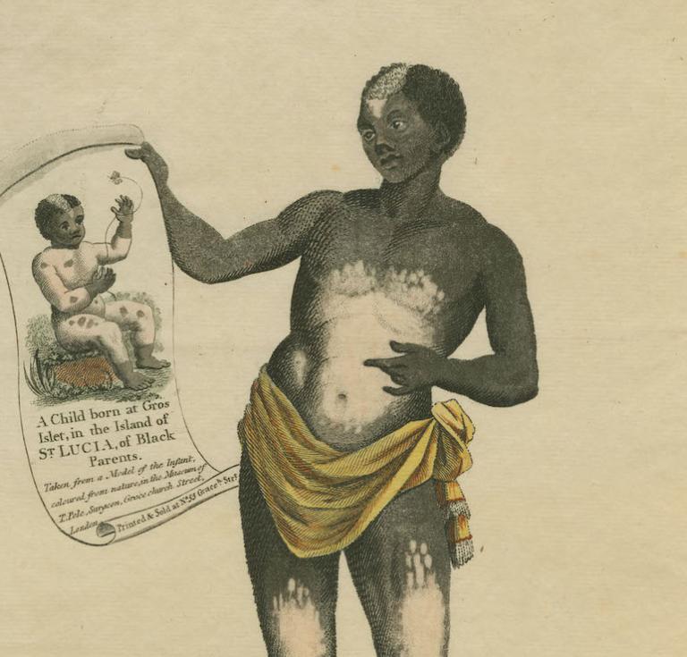 Circa-1789 print of an enslaved teen with vitiligo